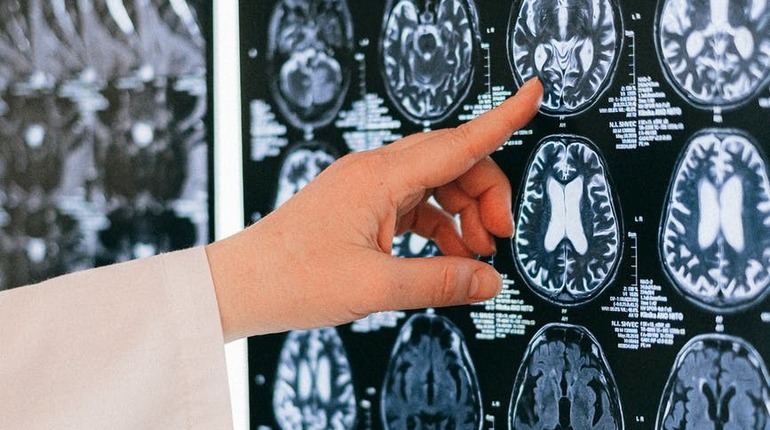 Ранние признаки болезни Альцгеймера: как заметить расстройство вовремя