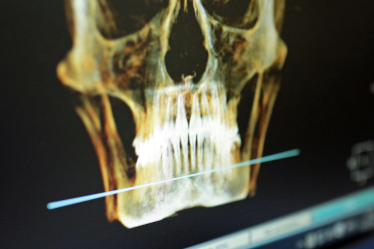 Стоматолог рассказала, как COVID-19 влияет на десны и зубы