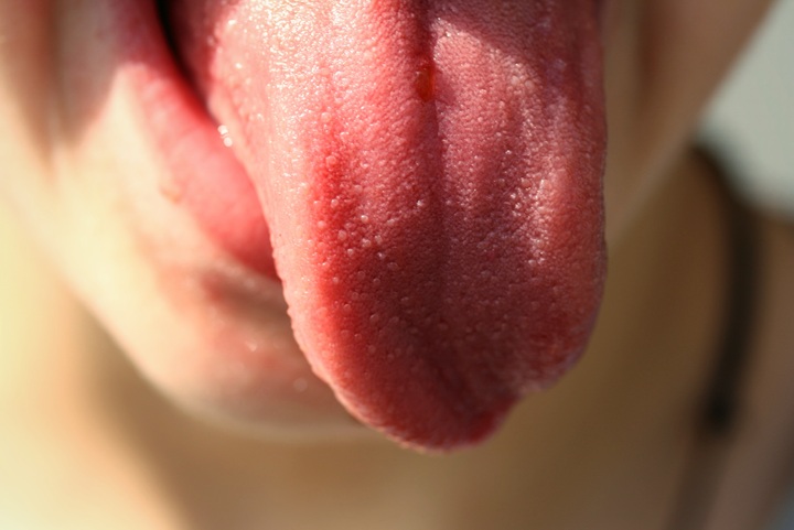 Врачи обнаружили еще один симптом «Пиролы»: его надо искать во рту