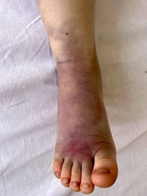 Врачи в Подмосковье спали 4-летнего ребенка после укуса гадюки